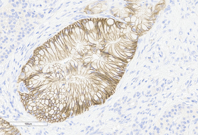 胰腺癌样本-20X
